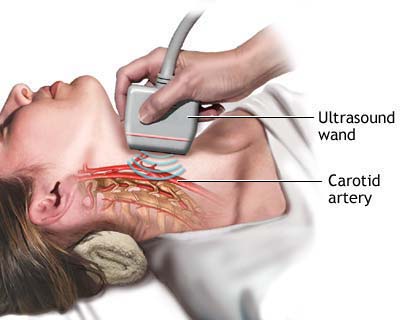 Carotid%20Ultrasound