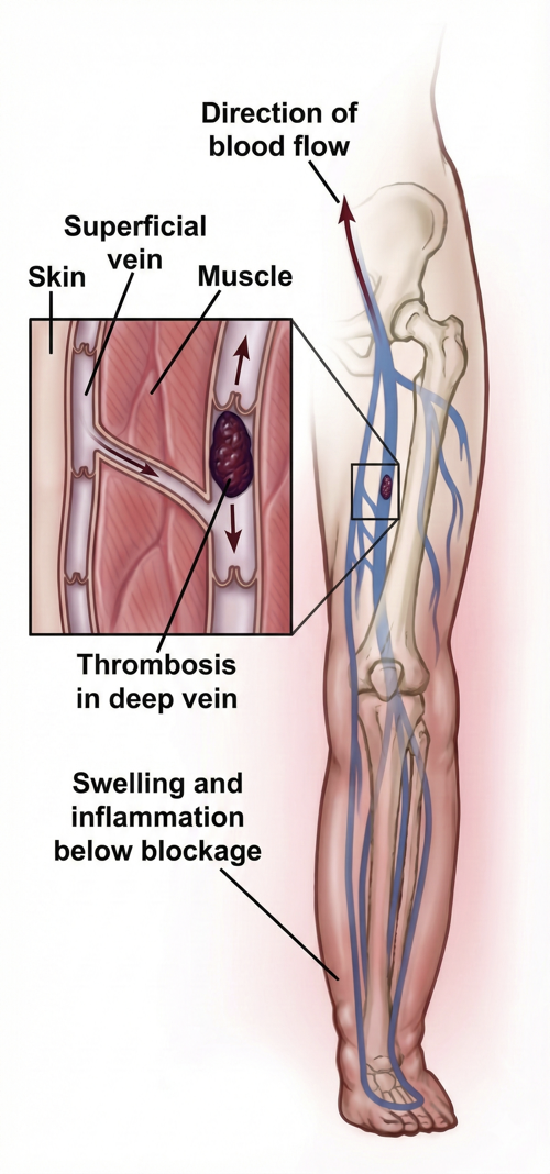 Deep Vein Thrombosis (DVT)