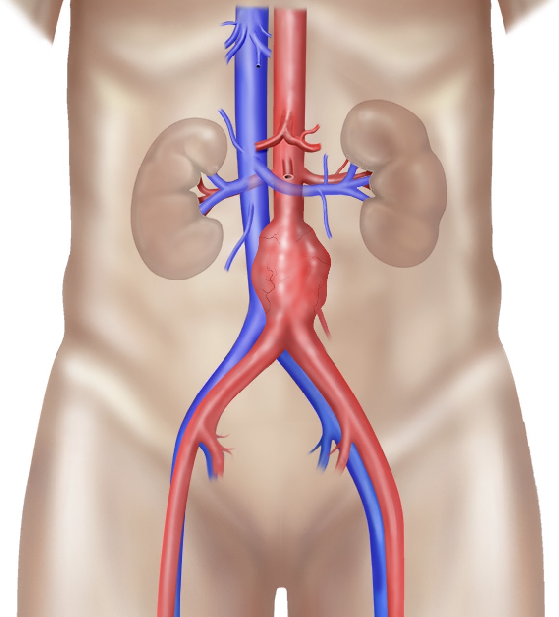 Aorta aneurysm